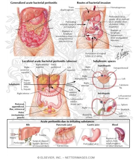 Acute Peritonitis