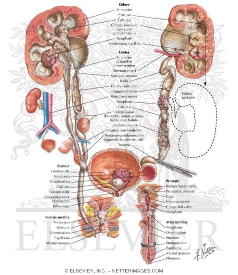 Obstructive Uropathy: Etiology