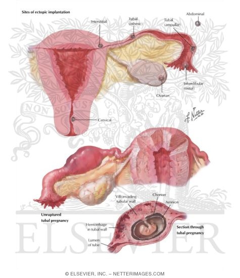 Watermarked preview of labeled image: Ectopic Pregnancy