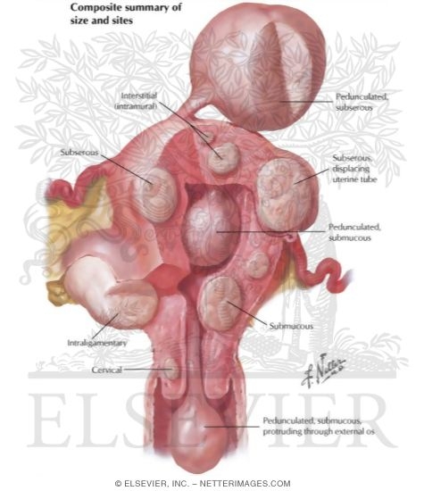 Watermarked preview of labeled image: Myoma (Fibroid) I - Locations