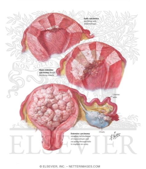 Watermarked preview of labeled image: Cancer of Corpus I - Various Stages and Types
