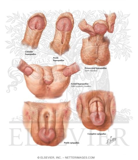 Watermarked preview of labeled image: Hypospadia, Epispadia