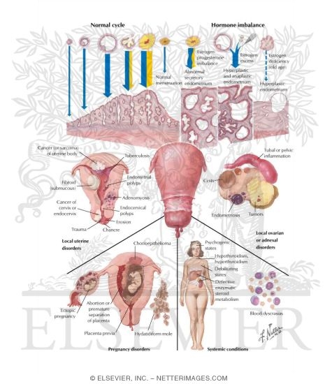 Watermarked preview of labeled image: Functional and Pathological Causes of Uterine Bleeding
Dysfunctional Uterine Bleeding