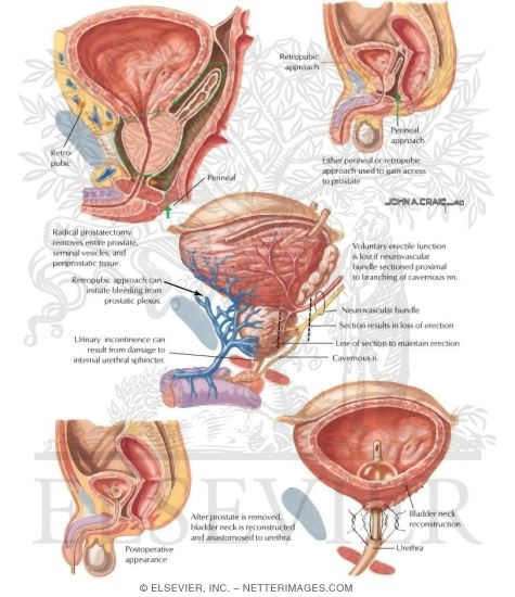 Watermarked preview of labeled image: Radical Prostatectomy