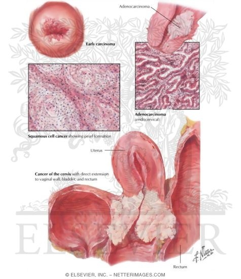 phd thesis on cervical cancer