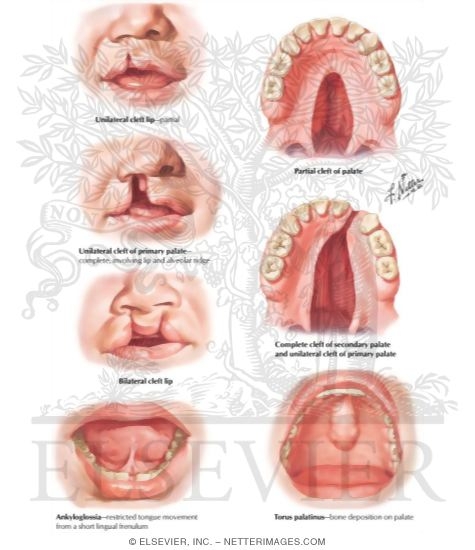 Congenital Anomalies of Oral Cavity