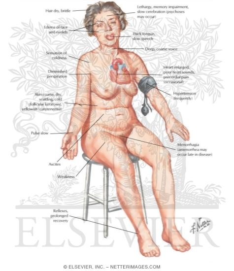 Watermarked preview of labeled image: Primary and Secondary Adult Myxedema
Hypothyroidism