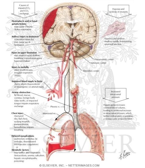 Watermarked preview of labeled image: Causes and Effects of Impaired Respiratory Exchange