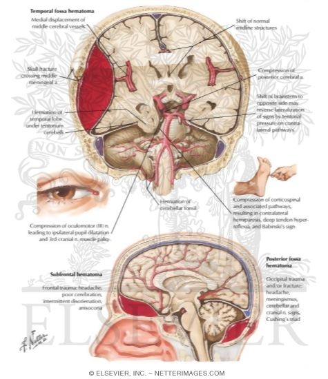 Epidural Hemorrhage