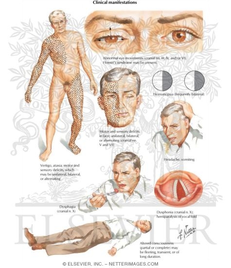 Watermarked preview of labeled image: Clinical Manifestations of Vertebrobasilar Territory Ischemia