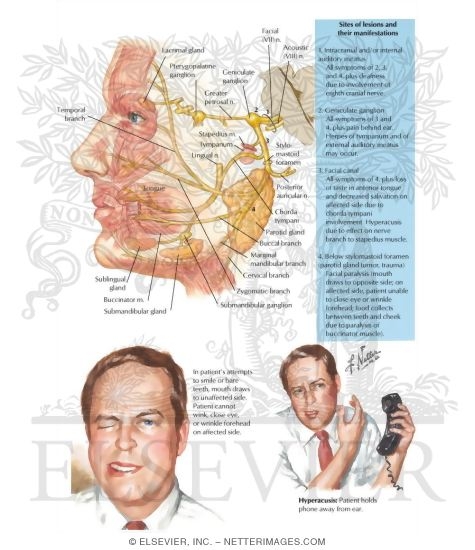 Bell's Palsy