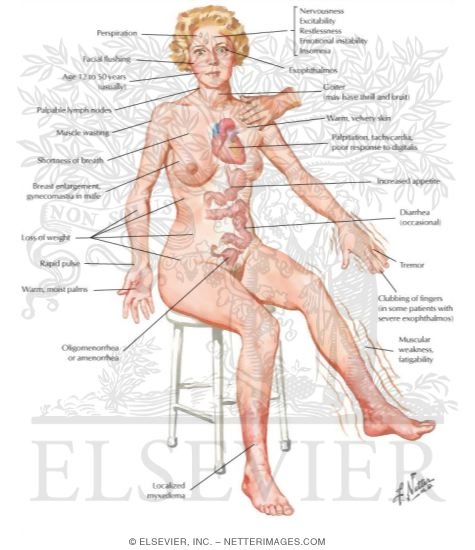 Hyperthyroidism With Diffuse Goiter (Graves' Disease)