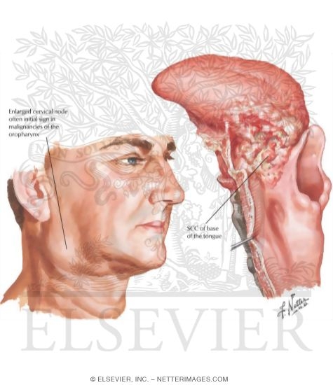 Watermarked preview of labeled image: Malignant Tumors of Oropharynx