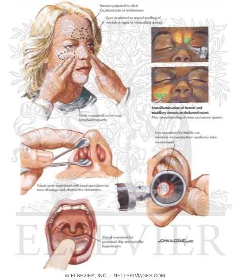 Watermarked preview of labeled image: Physical Examination of the Nasal Cavity