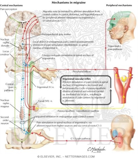 Watermarked preview of labeled image: Mechanisms in Migraine