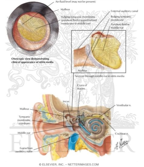 Otitis Media