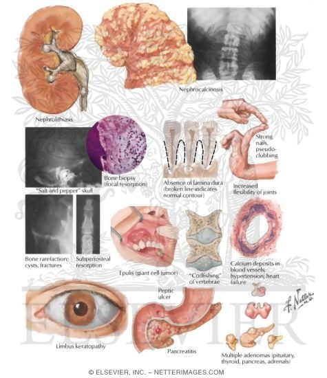 Watermarked preview of labeled image: Pathology and Clinical Manifestations of Hyperparathyroidism