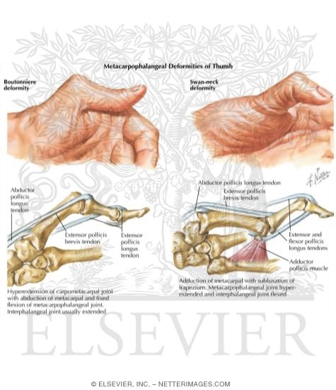 Deformities of the Thumb Ray