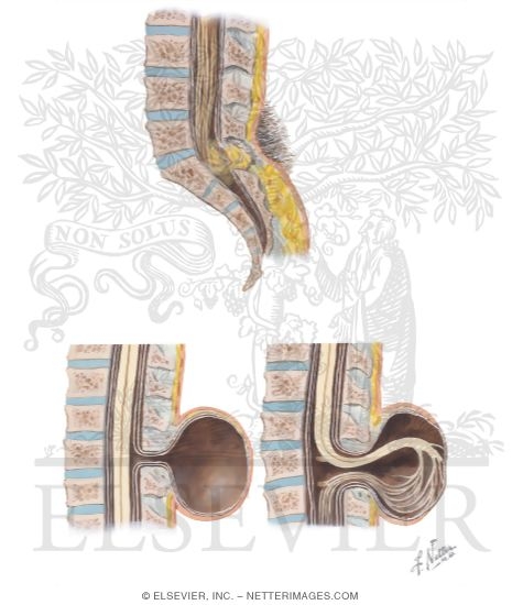 Watermarked preview of unlabeled image: Spina Bifida