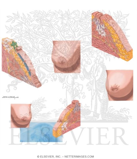 Watermarked preview of unlabeled image: Breast Cancer