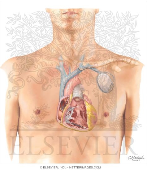 Cardiac Defibrilators