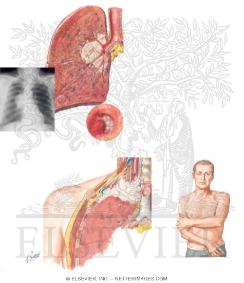 Watermarked preview of unlabeled image: Lung Cancer