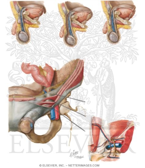 Watermarked preview of unlabeled image: Inguinal Hernias