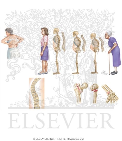Watermarked preview of unlabeled image: Osteoporosis