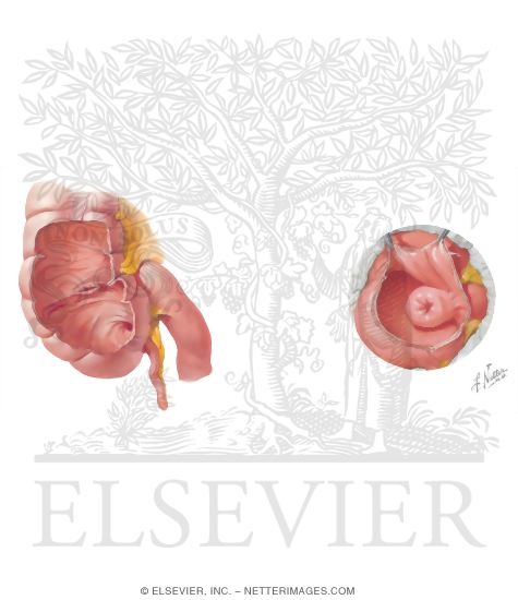 Watermarked preview of unlabeled image: The Ileocecal Junction and Valve