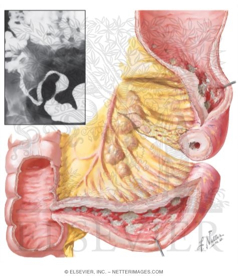 Crohn Disease