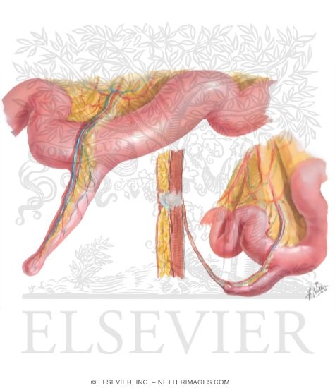 Meckel's Diverticulum