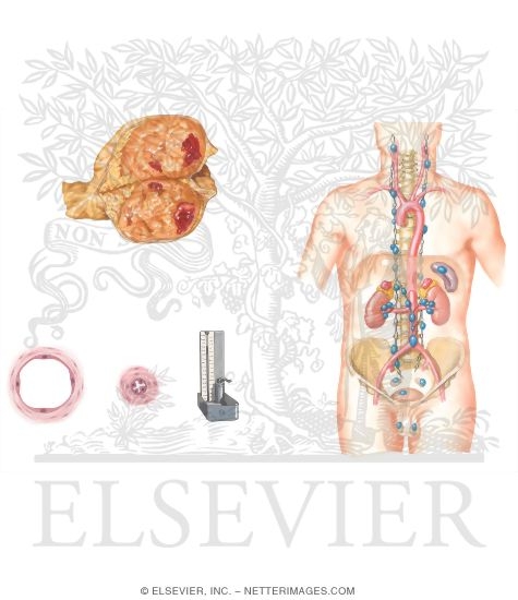 Pheochromocytoma