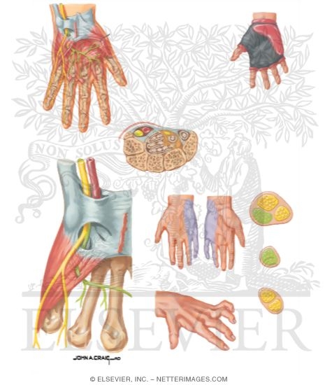 Watermarked preview of unlabeled image: Ulnar Tunnel Syndrome