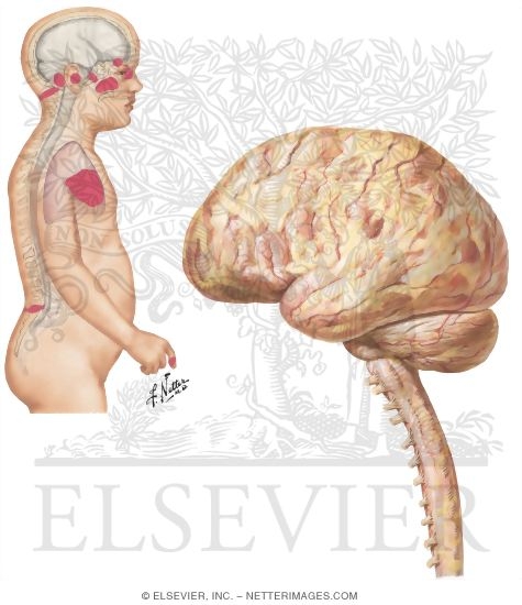 Watermarked preview of unlabeled image: Meningitis