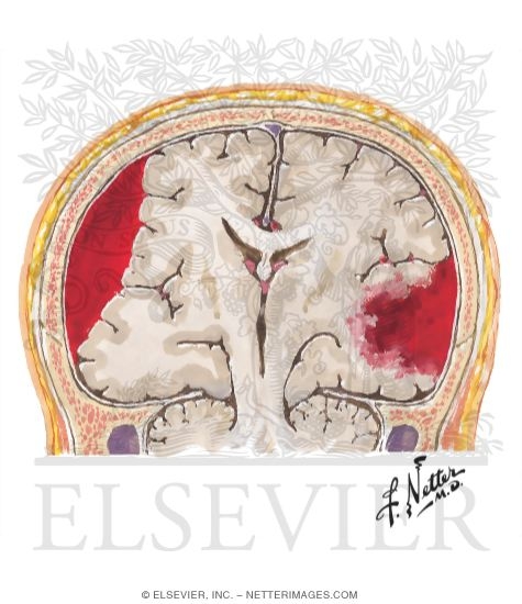 Subdural Hematomas