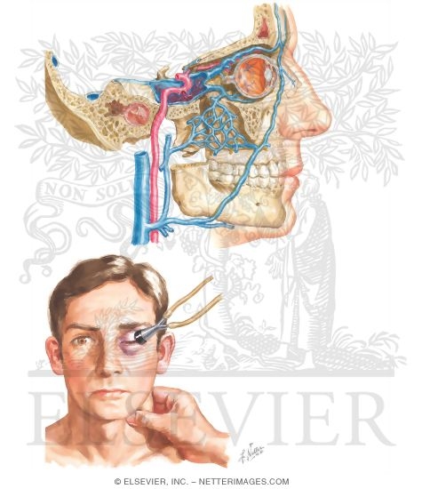 Carotid-cavernous Sinus Fistula