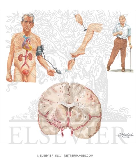 Vascular (Multi-Infarct) Dementia