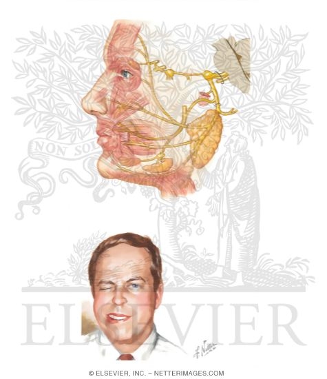 Watermarked preview of unlabeled image: Facial Nerve (Bell's) Palsy