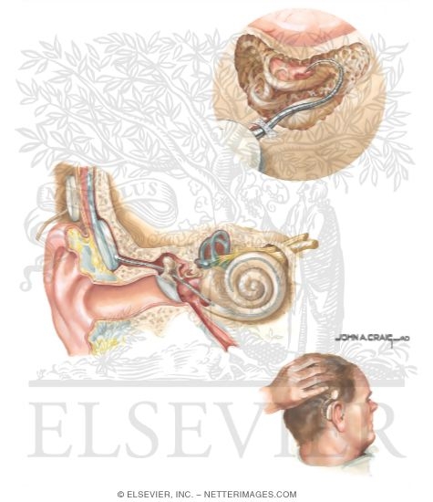 Watermarked preview of unlabeled image: Cochlear Implant