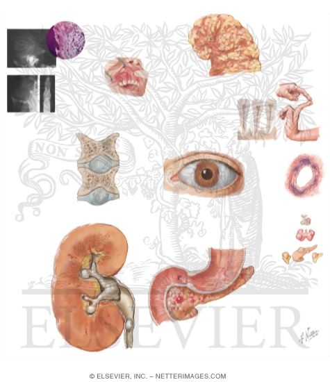 Watermarked preview of unlabeled image: Manifestations of Primary Hyperparathyroidism
