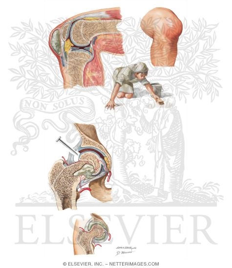 Watermarked preview of unlabeled image: Septic Bursitis and Arthritis