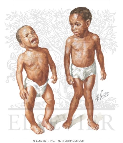 Genu Varum and Valgum