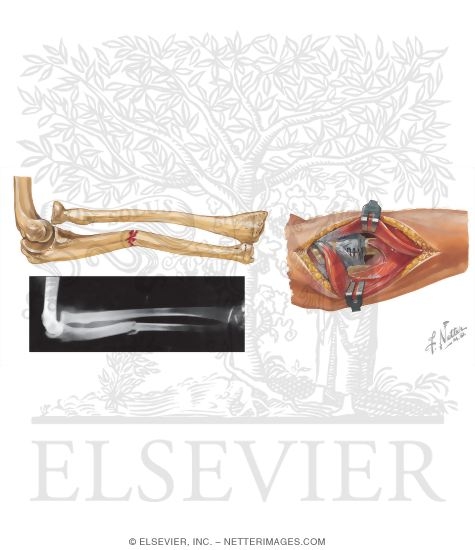 Watermarked preview of unlabeled image: Fracture of the Ulna Shaft