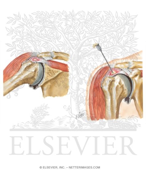 Watermarked preview of unlabeled image: Shoulder Tendinitis and Bursitis
