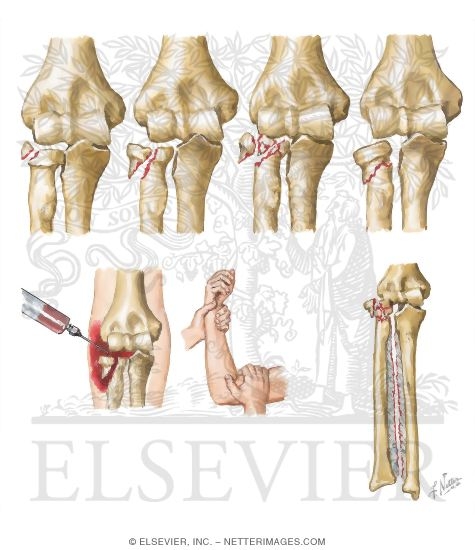 Fracture of the Radial Head and Neck