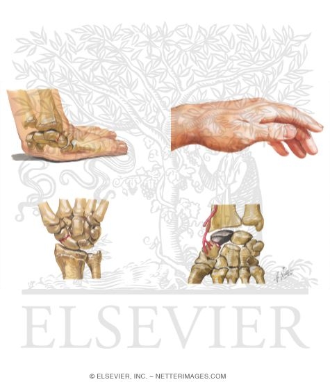 Watermarked preview of unlabeled image: Fracture of Scaphoid