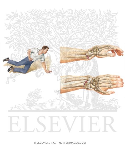 Watermarked preview of unlabeled image: Distal Radial (Colles') Fracture