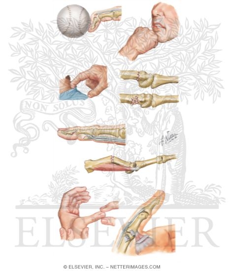 Watermarked preview of unlabeled image: Finger Injuries