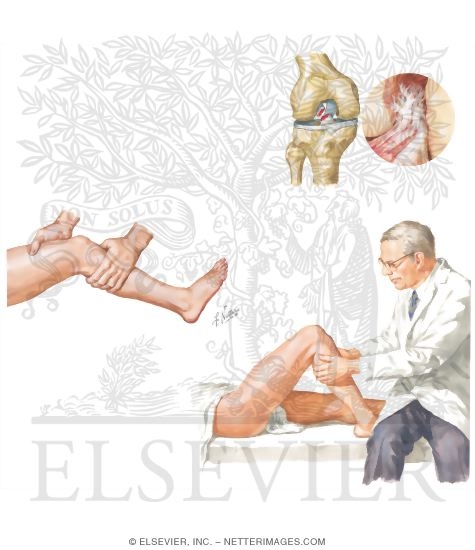 Watermarked preview of unlabeled image: Rupture of the Anterior Cruciate Ligament
