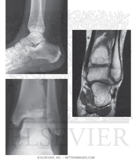 Ankle arthrodesis surgery image